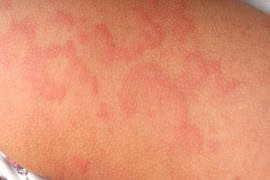 hives treatment dallas